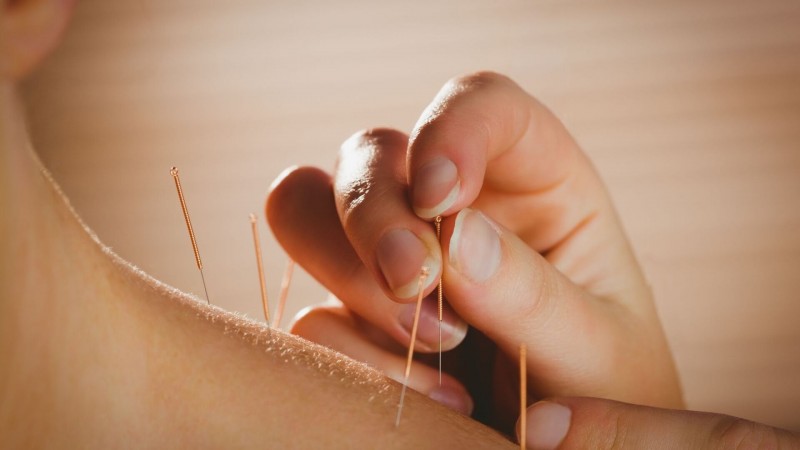 acupuntura ansiedade